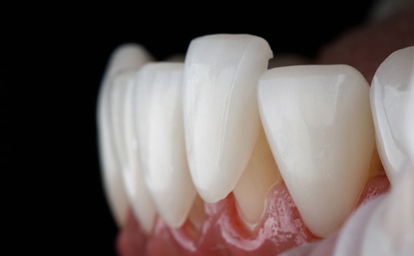 Image of veneers placed on teeth
